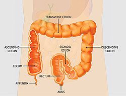 Bleeding in the colon may occur from a diverticulum