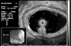  endoscopic ultrasonography,