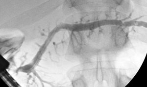 What can I expect during ERCP?