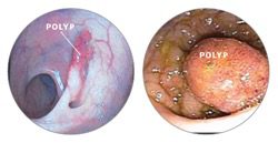 polyps images